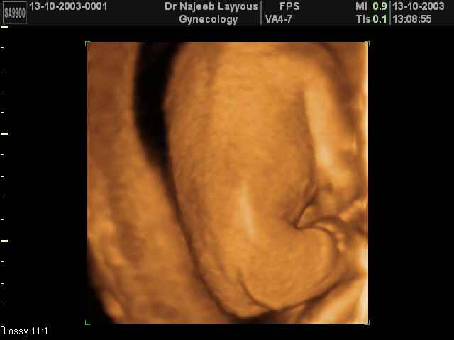 Fetal Back and Bottom