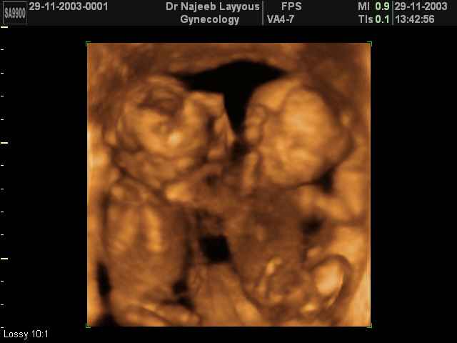 Twins Pregnancy
